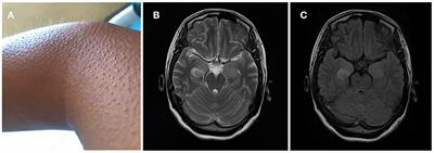 Pilomotor Seizures in a Patient With LGI1 Encephalitis